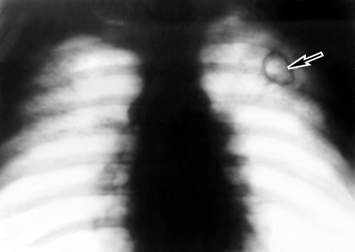 Туберкулёз органов дыхания. Рис. 28