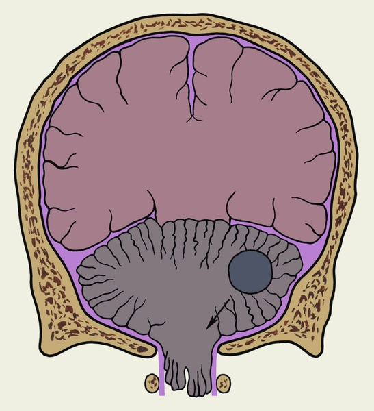 Дислокация головного мозга. Рис. 1