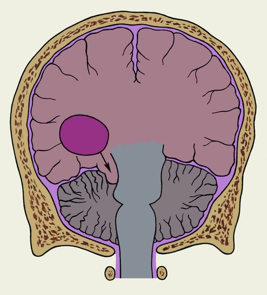 Дислокация головного мозга