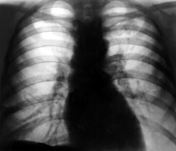 Туберкулёз органов дыхания. Рис. 13