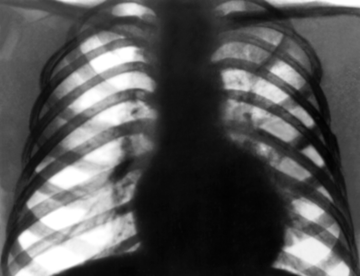 Туберкулёз органов дыхания. Рис. 15