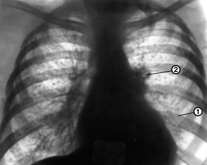 Туберкулёз органов дыхания. Рис. 18