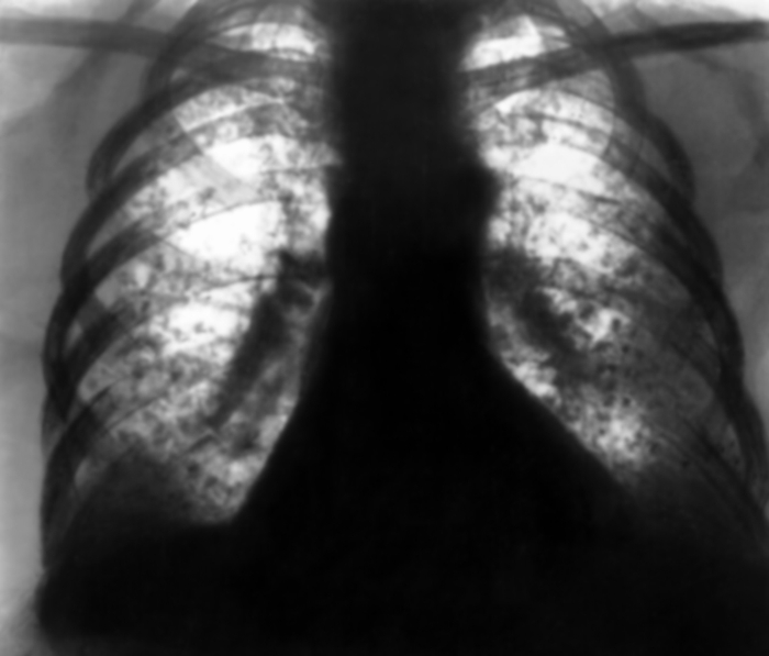 Туберкулёз органов дыхания. Рис. 21