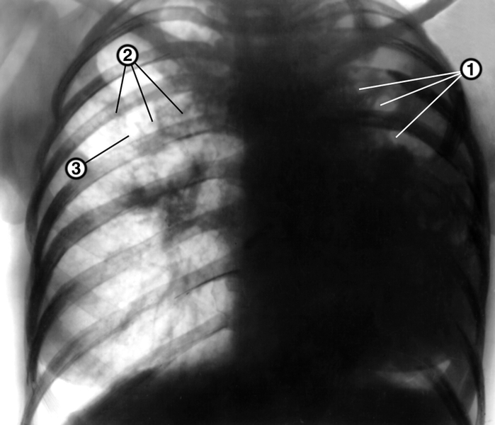 Туберкулёз органов дыхания. Рис. 31