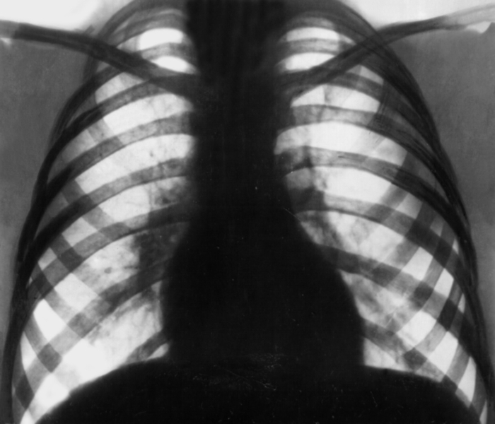 Туберкулёз органов дыхания. Рис. 32