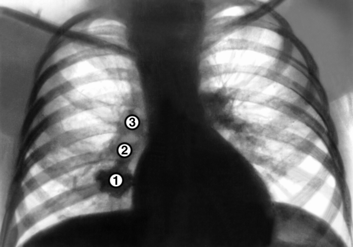 Туберкулёз органов дыхания. Рис. 6