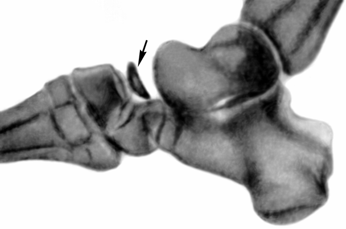 Болезнь келлера стопы. Остеохондропатия ладьевидной кости Келлер 1. Ладьевидная кость стопы болезнь Келлера. Болезнь Фрейберга Келера.