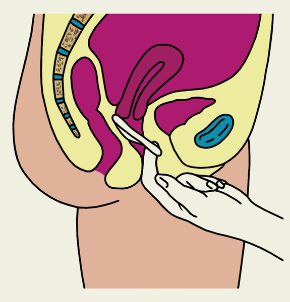 Контрацепция. Рис. 4