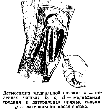 десмотомия