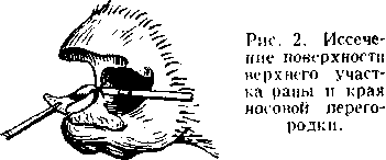 ринопластика. Рис. 2