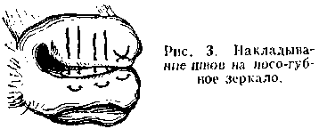 ринопластика. Рис. 3